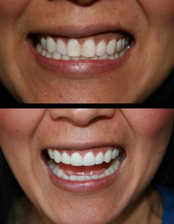 Jacksonville Teeth Whitening Dentists Fl